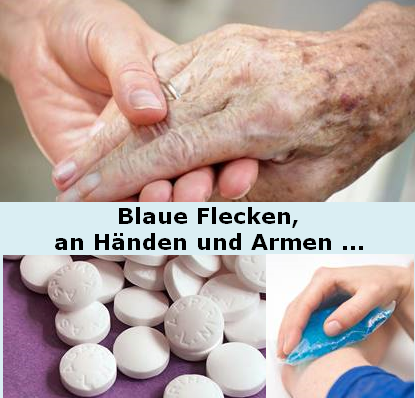 Blaue Flecken und Händen und Armen.PNG